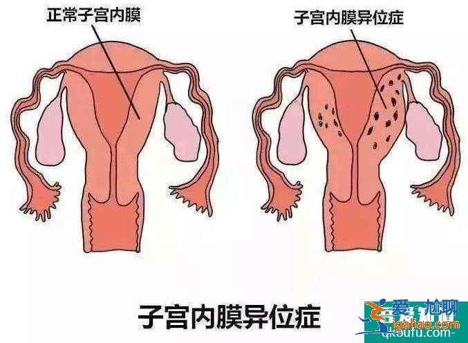 试管婴儿超长方案好不好？费用多少？？