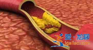 动脉硬化如何饮食？？