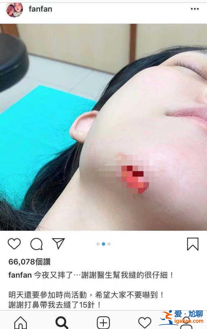 又可怜又搞笑！范玮琪摔倒下巴被缝15针，网友评论从一片心疼转为催生现场！