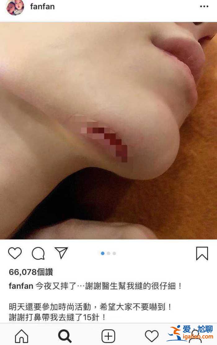 又可怜又搞笑！范玮琪摔倒下巴被缝15针，网友评论从一片心疼转为催生现场！