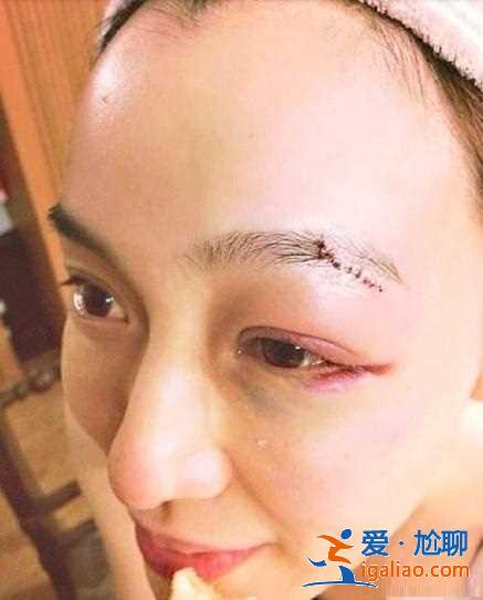又可怜又搞笑！范玮琪摔倒下巴被缝15针，网友评论从一片心疼转为催生现场！
