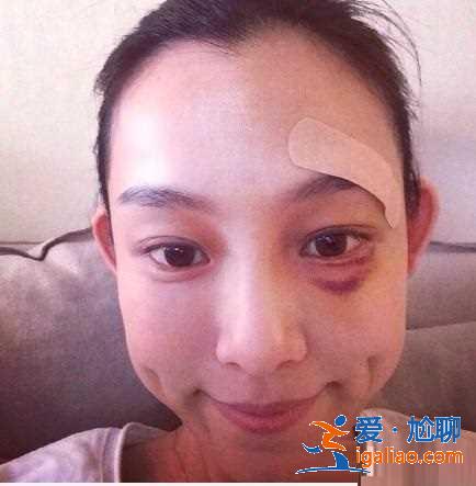 又可怜又搞笑！范玮琪摔倒下巴被缝15针，网友评论从一片心疼转为催生现场！