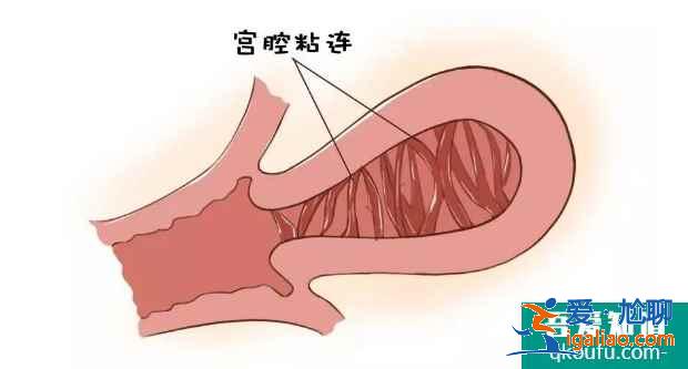 重度宫腔粘连，赴美做试管婴儿选用哪种方案？？