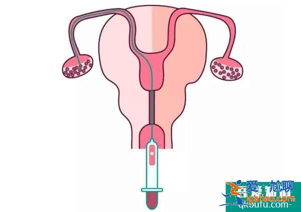 年龄与卵泡数量的关系，试管专家从5方面提高取卵个数？