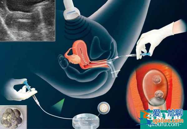 解惑：赴美做试管婴儿还需要做宫腔镜检查吗？？
