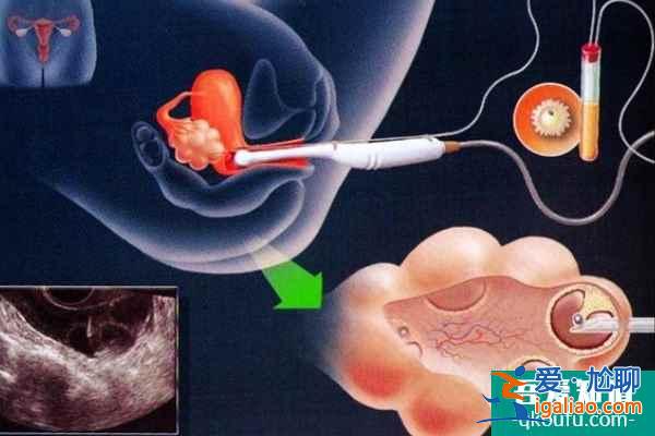 定制试管婴儿科学治疗步骤？