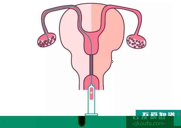 高龄女性去做试管婴儿，IVF专家从五个方面着手提高取卵数量？