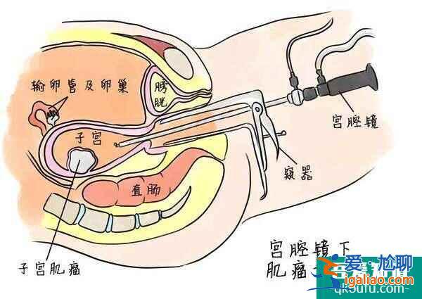 解读：试管婴儿促排，会不会使肌瘤增大?？