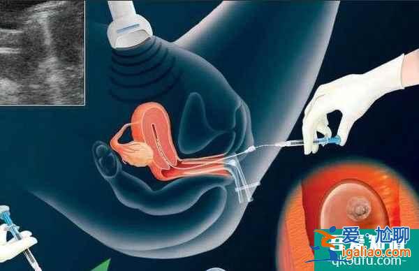 资讯：试管婴儿四个步骤规避宫外孕的发生？