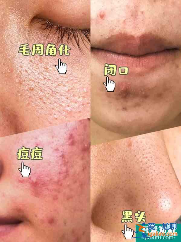 女明星的护肤方法解决了我的痘痘痘印问题！？