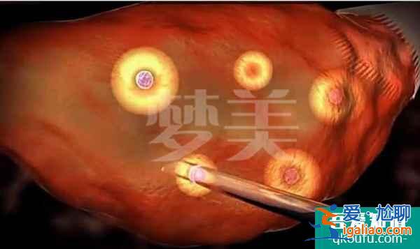 单身女性赴美做试管婴儿攻略:需做好准备? 单身女性赴美做试管婴儿攻略:需做好准备?