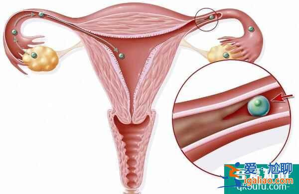 二胎怀不上，80%输卵管因素导致？