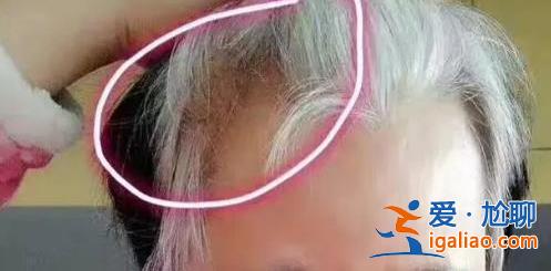 女子阳性后头发一夜变白脱发，，阳了后的个性化症状[阳了后的个性化症状]？