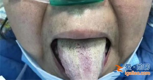 女子感染新冠阳了舌头长满白舌苔？