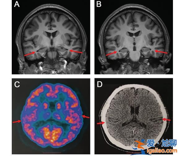 19岁男生患阿尔兹海默症 研究参与者曾不相信检查结果? 19岁男生患阿尔兹海默症 研究参与者曾不相信检查结果?