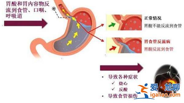 患胃食管反流17年，男子接受手术后终于能“躺平”获新生[手术治疗]？