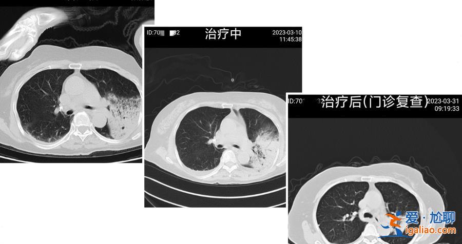 上海77岁阿婆感染“鹦鹉热”呼吸衰竭 多家医院收到类似病例？