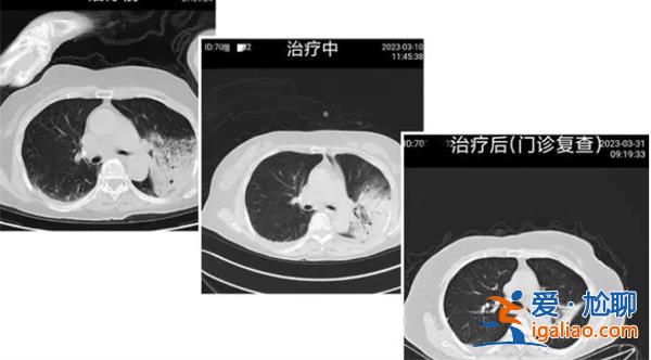 77岁阿婆感染“鹦鹉热”导致呼吸衰竭，或是飞禽惹的祸[77岁阿婆感染]？