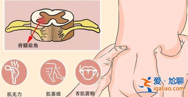 青少年成人SMA临床诊疗指南，患者类型更加细化[临床诊疗指南]？