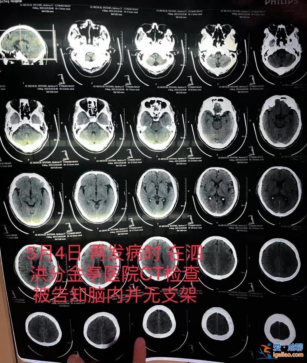 江苏一患者因脑梗去世 医生承认此前未成功植入脑血管支架并隐瞒？