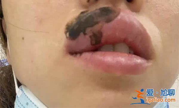 女子睡觉被蜈蚣咬醒，嘴肿成“香肠”注意安全防范[香肠]？