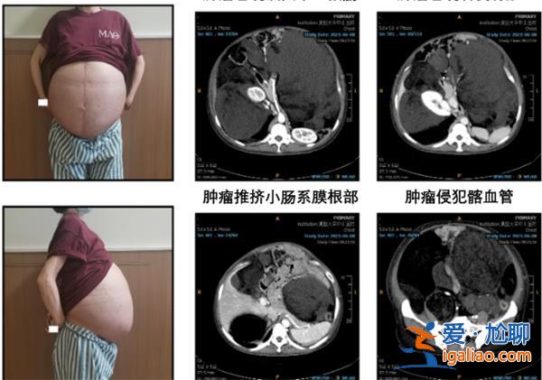 女子回国求医医生历经5小时切除其腹腔重达25公斤肿瘤？