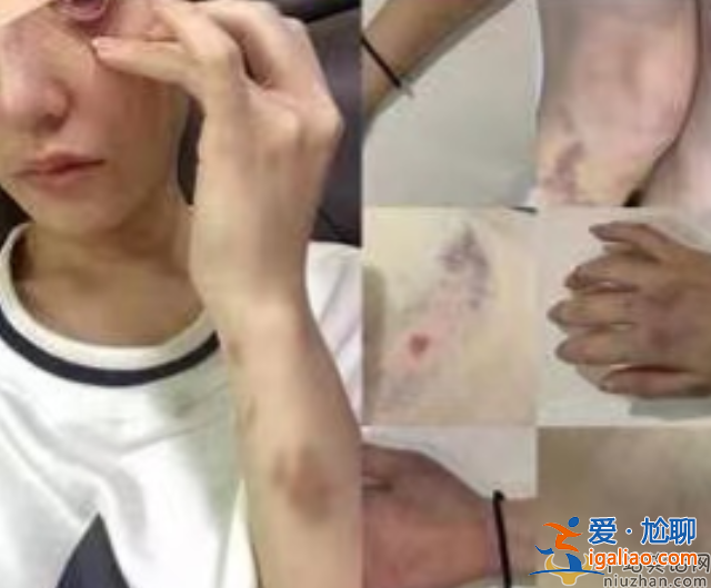 网红蔡瑛纹被男友家暴致流产，控诉男方吃软饭还劈腿
