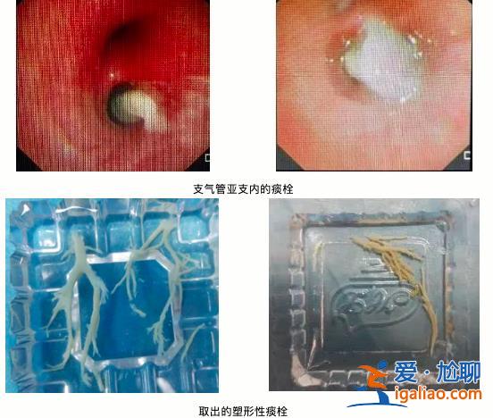 7岁男童肺部实变 有医院一天最高峰67例“洗肺”？