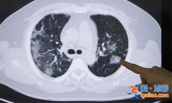 29岁姑娘确诊肺癌？