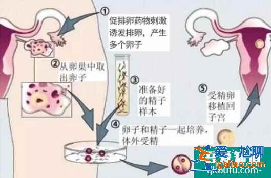 人工授精多次失败后还可以做试管婴儿吗?？
