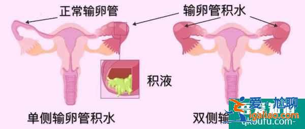 输卵管积水的女性赴美做试管婴儿，有什么样的方案？？