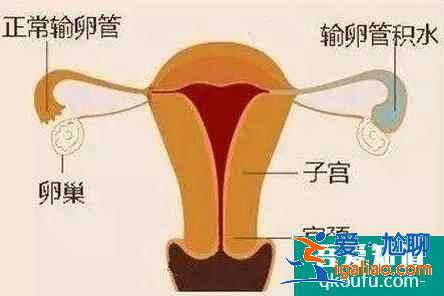 输卵管积水还能做试管婴儿吗？是否会对试管成功率有影响？？