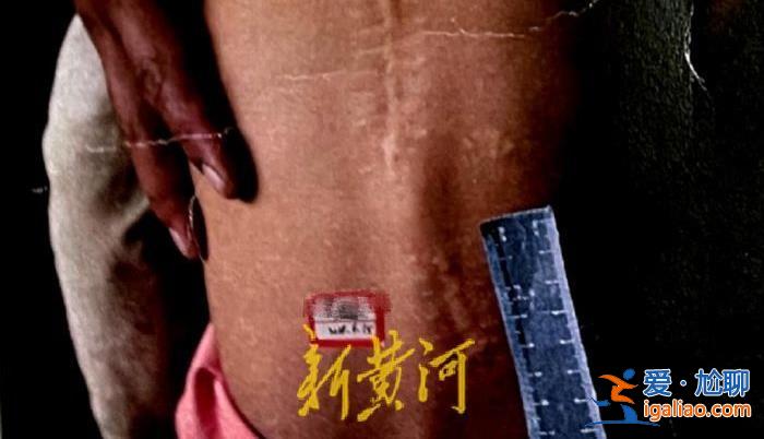 云南3岁女童被枪打伤后与23颗弹片“共生”8年 伤人者被立案后又撤销？